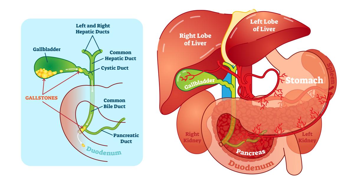 Calculs Dans Le Cholédoque | Calculs Cholédociens En Radiologie – QNAG