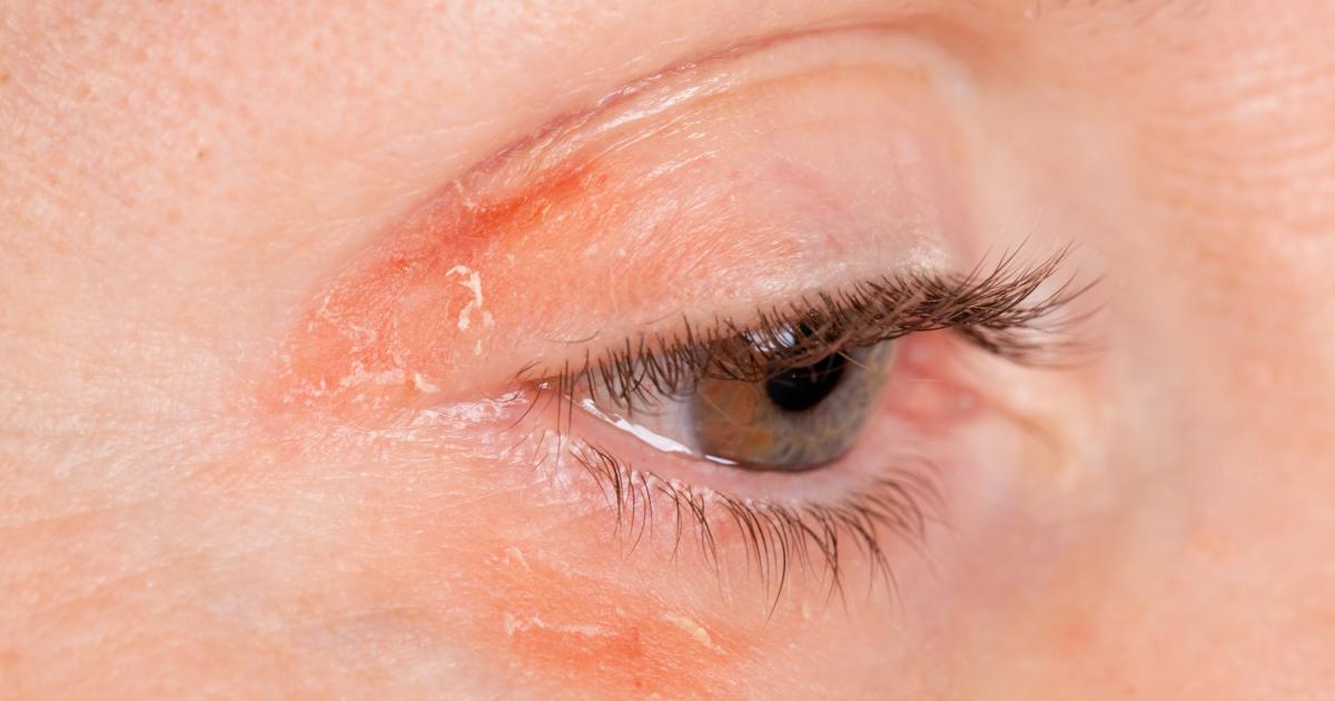 Psoriasis du visage Que faire en cas de psoriasis près des yeux
