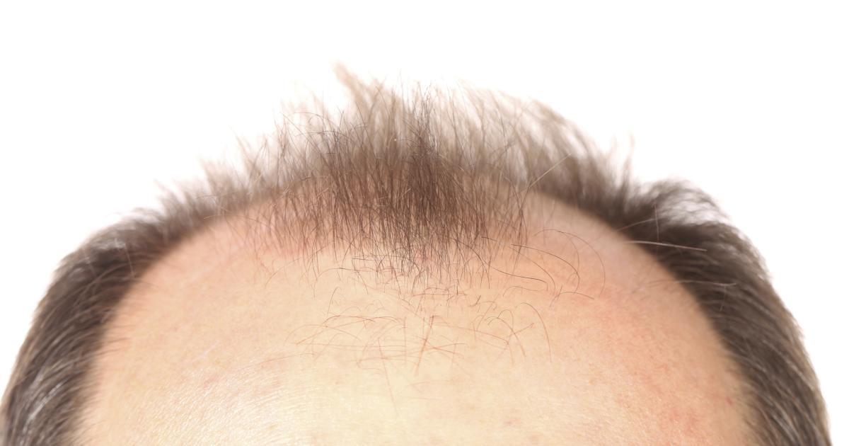 Douleur du cuir chevelu Symptômes, causes, traitements