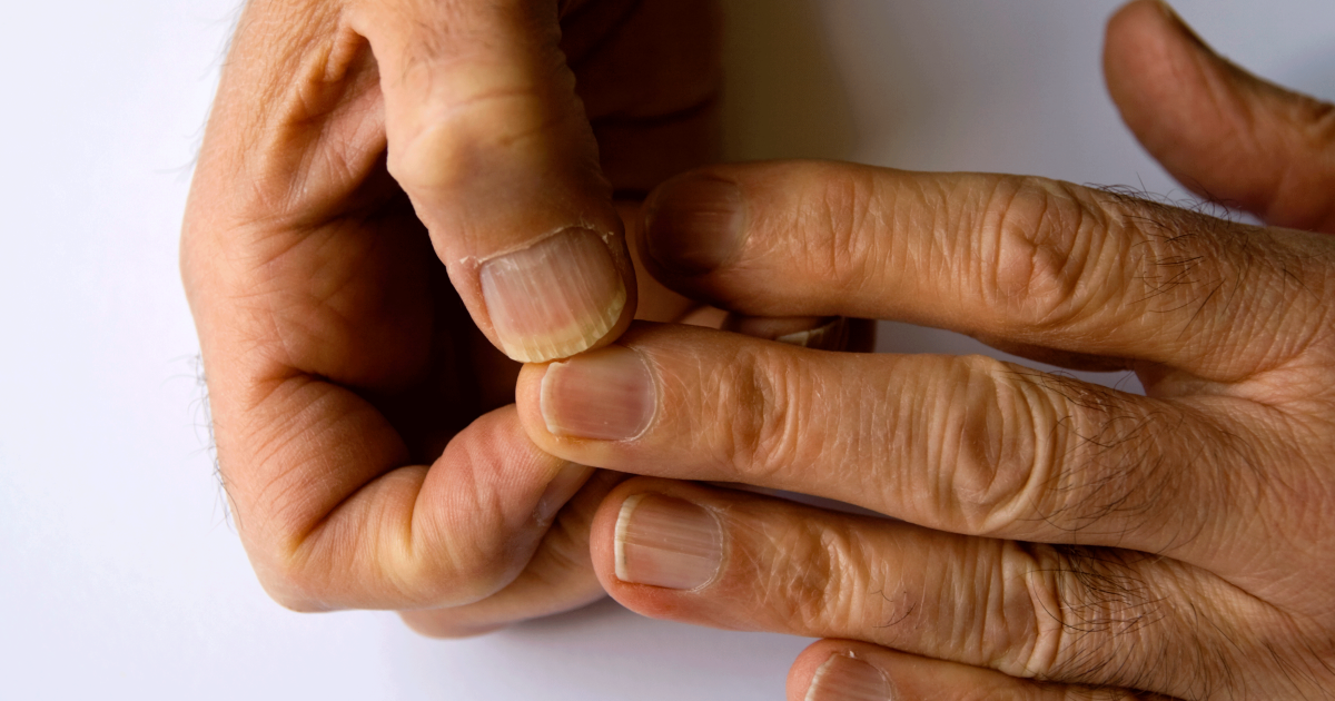Peut On Etre Devierger Avec Un Doigt Doigt enflé - Doigts enflés - Symptômes, causes, traitements, diagnostic