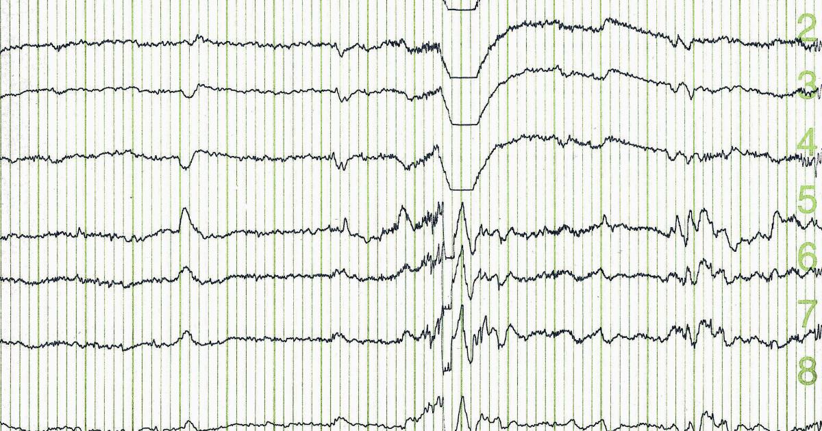 Comprendre les résultats de votre EEG EEG normaux et anormaux