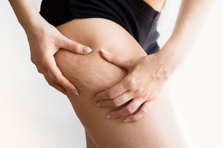 Qu'est-ce que la cellulite ? Définition, causes et traitements